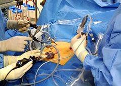 Операция по удалению слизистой желудка с подслизистой диссекцией впервые выполнена в эндоскопическом отделении ГКБ 81