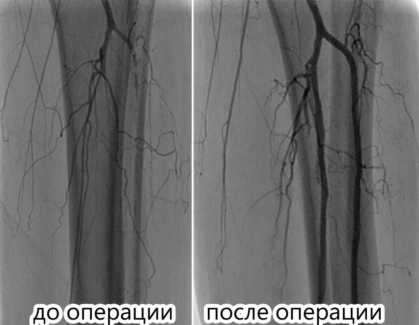 Рентгенохирурги больницы Вересаева спасли от ампутации единственную ногу пациентки
