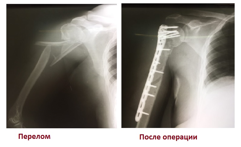 Травматологи больницы Вересаева восстановили пациентке раздробленное плечо