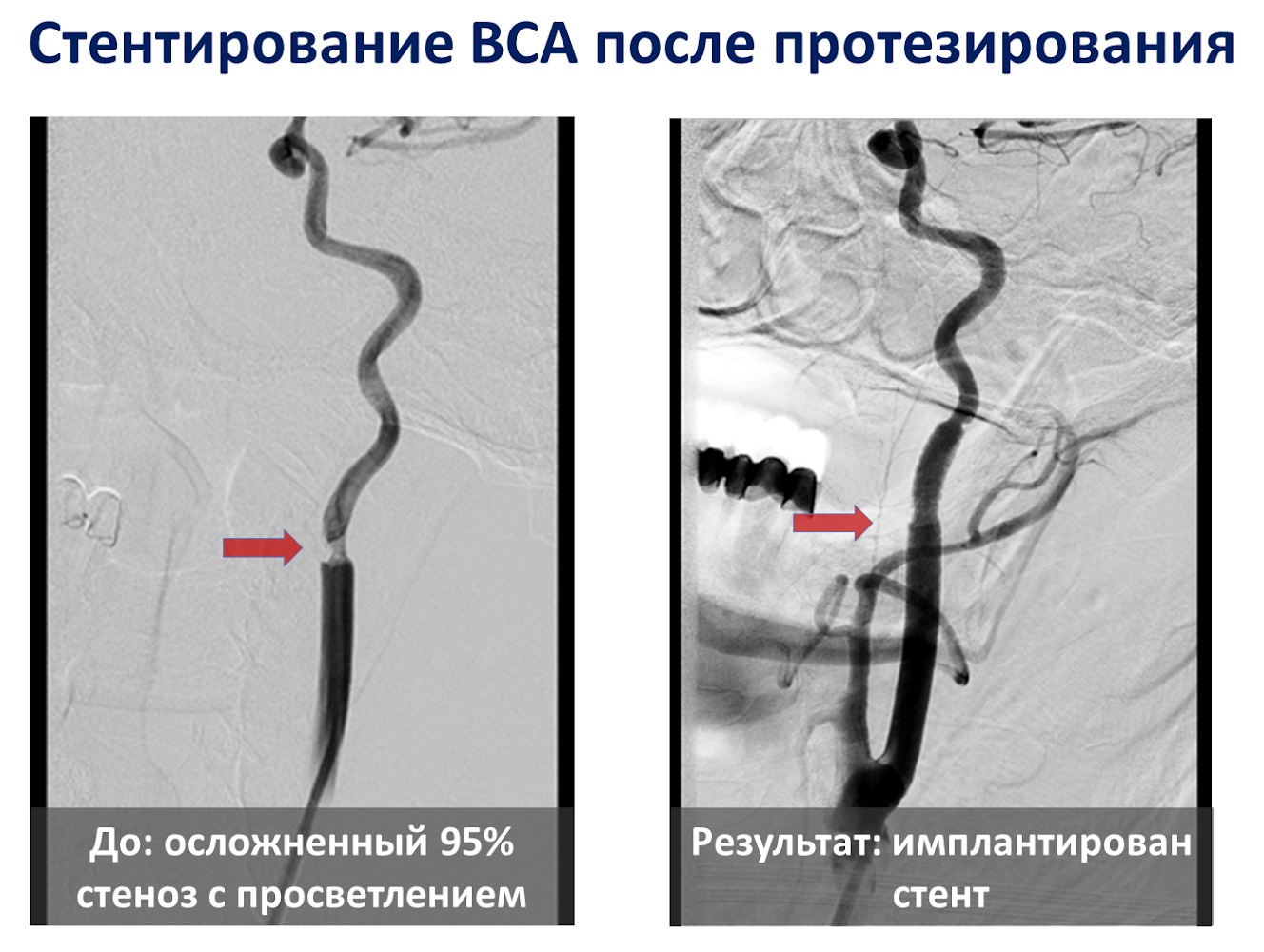 Врачи больницы Вересаева впервые выполнили экстренную гибридную операцию на внутренней сонной артерии