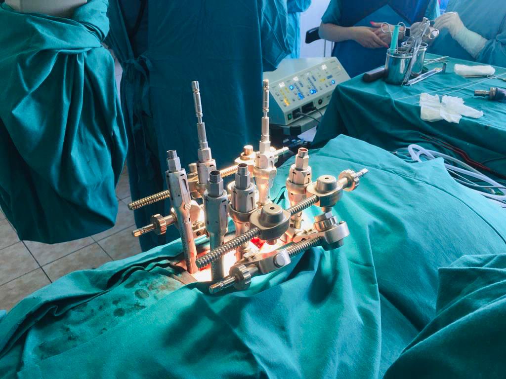 Высокотехнологичную операцию на позвоночнике с выключением одного легкого провели нейрохирурги больницы Вересаева