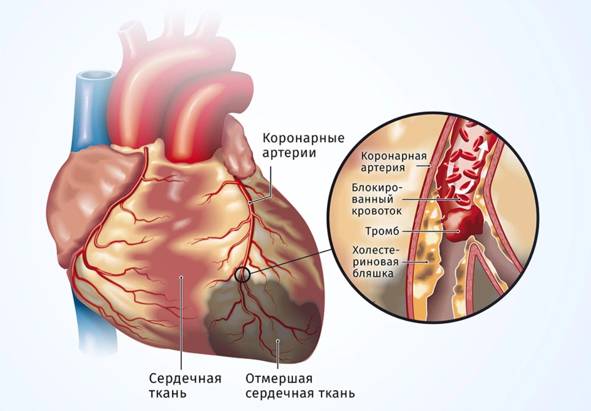 тромб в коронарных артериях