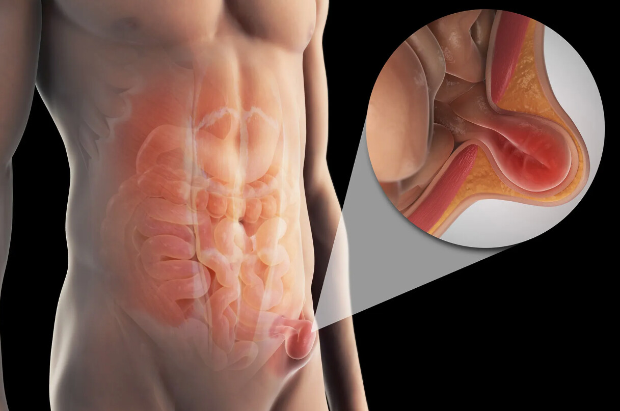 5 мифов о паховой грыже