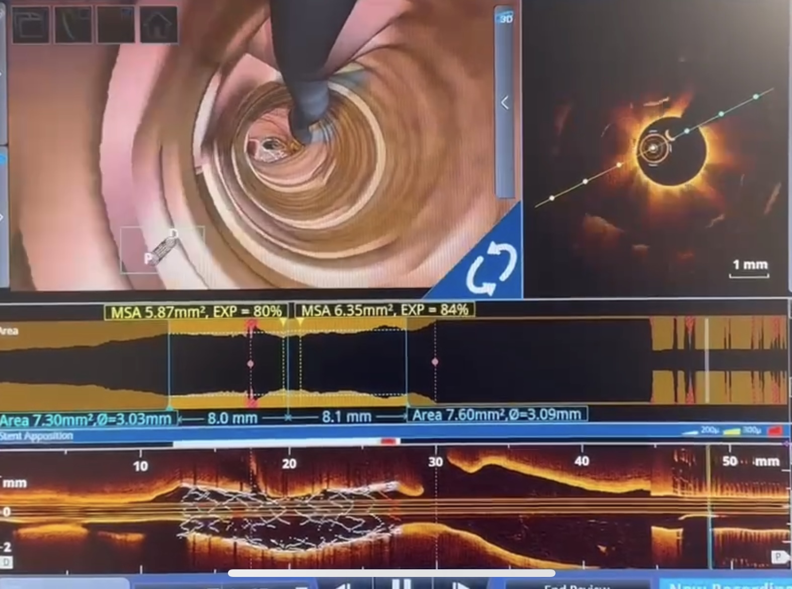 Как современные технологии делают лечение сосудов сердца еще эффективнее
