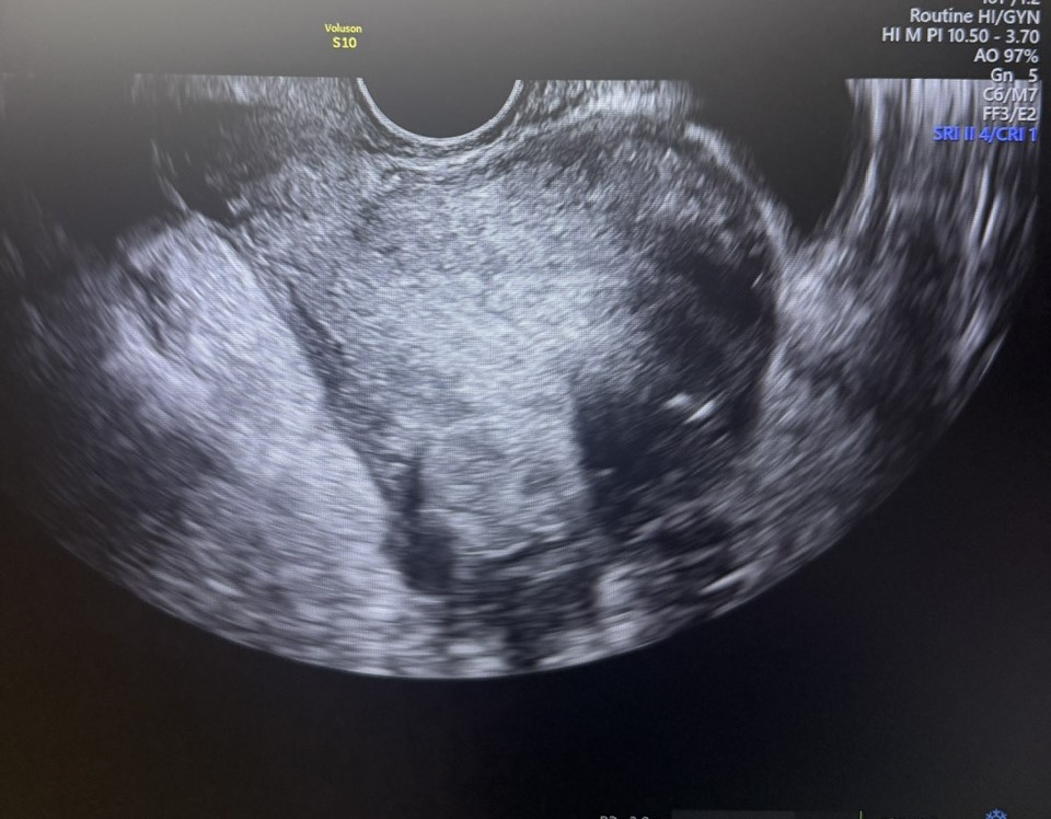 Специалисты ГКБ им. В.В.Вересаева сохранили возможность стать мамой женщине с множественной миомой матки