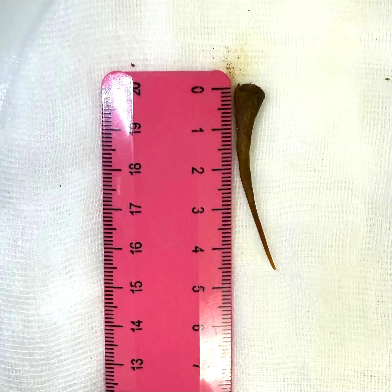 Врачи извлекли из кишечника женщины рыбью кость, проткнувшую стенку органа