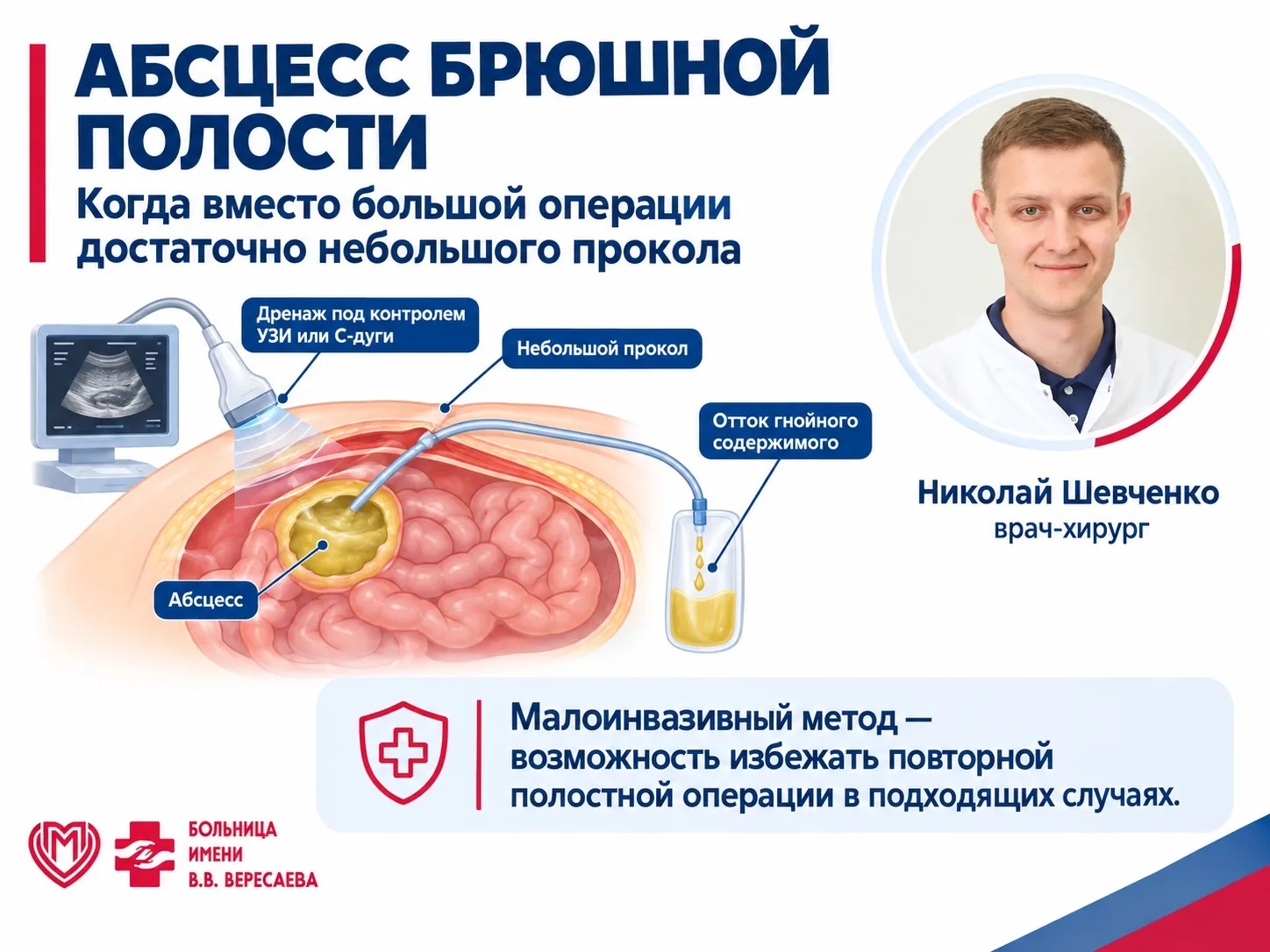 Абсцесс брюшной полости: когда вместо большой операции достаточно небольшого прокола